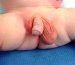 retencija-testisa-–-nespušteni-testis